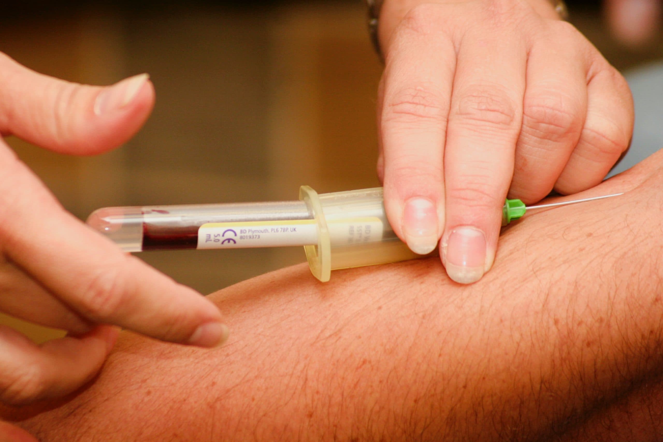 Regenerative micrografts prepared at London Cartilage Clinic